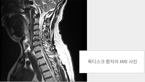 목디스크 환자의 MRI 사진