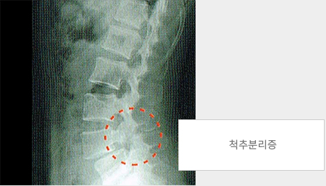 척추분리증