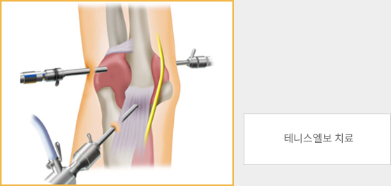 테니스엘보 수술