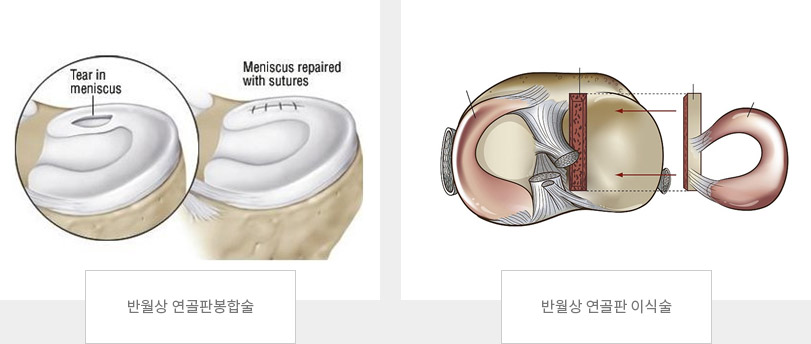 반월상 연골판봉합술, 반월상 연골판 이식술