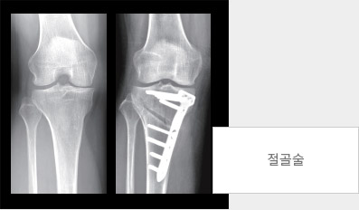 절골술