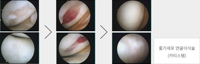 줄기세포 연골이식술 (카티스템)