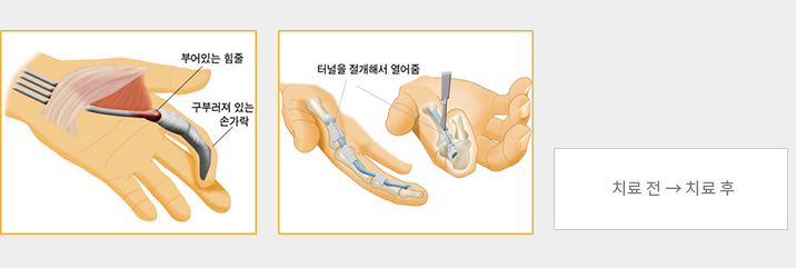 방아쇠수지 - 치료전후