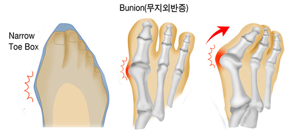 무지외반증