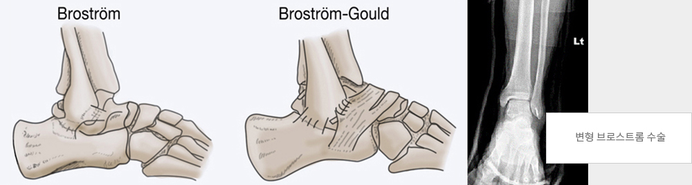 변형 브로스트롬 수술