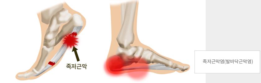 족저근막염(발바닥근막염)