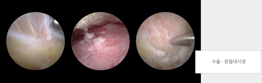 수술-관절내시경