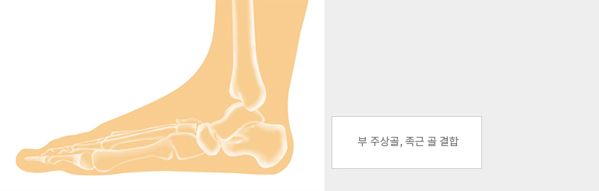 부 주상골, 족근 골 결합