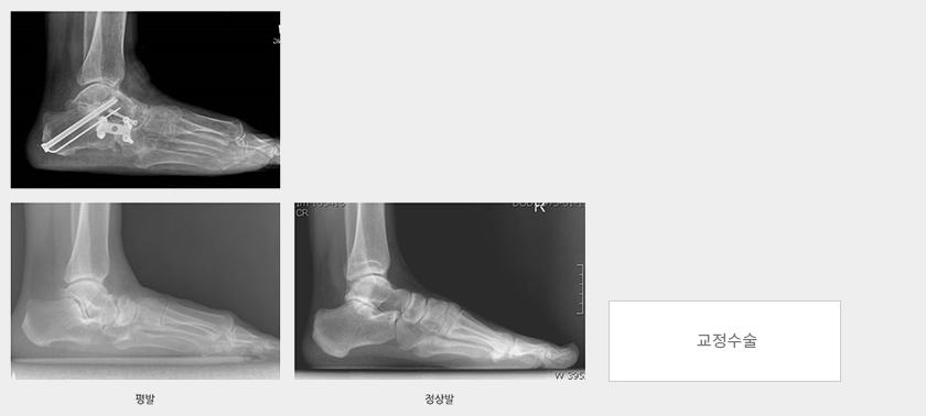 손목터널증후군