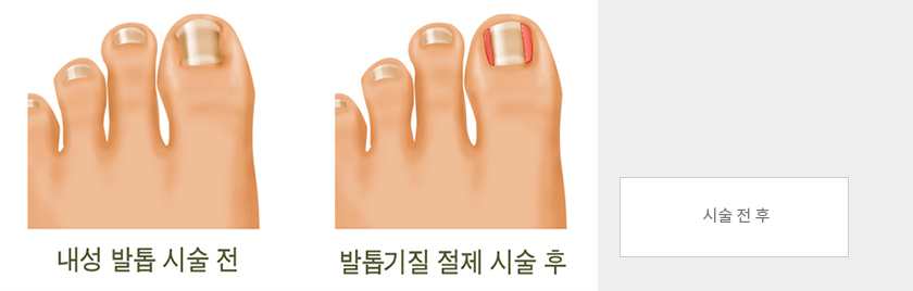 내성발톱