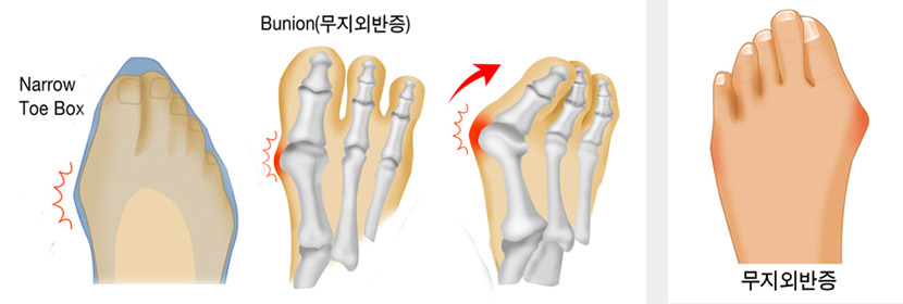 무지외반증