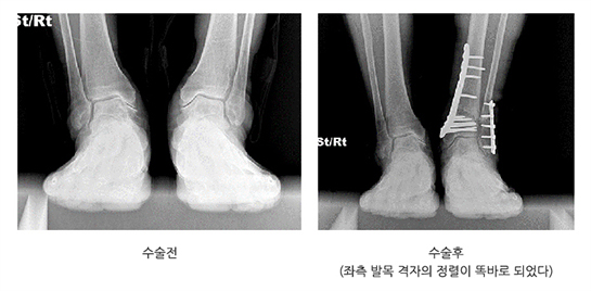 발목 중기 관절염의 치료