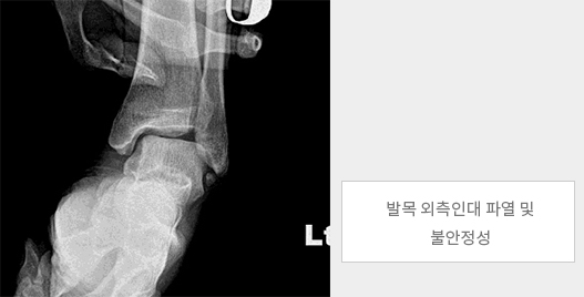 발목 외측인대 파열 및 불안정성