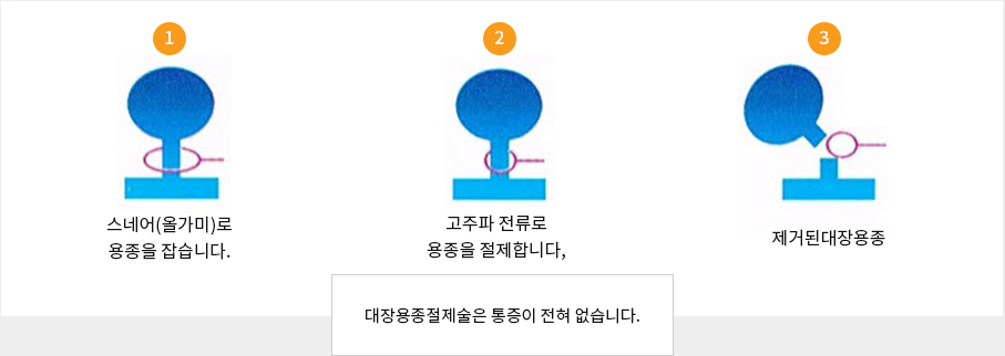 내시경적 용종(폴립) 절제술 : 대장용종절제술은 통증이 전혀 없습니다.